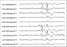 Interictal Eeg With Spikes Arising From The Mesial Temporal Lobe As Download Scientific Diagram