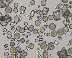 I feel pain the right bottom side? Types Of Crystals In Urine