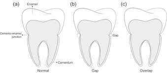 However, it is a challenge for doctors to diagnose, resulting in delayed or improper. Scaffolds For Dental Cementum Sciencedirect