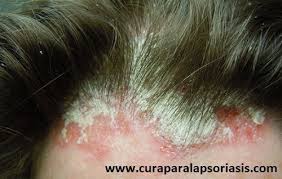 Tratamiento Para La Psoriasis En El Cuero Cabelludo Psoriasis Del Cuero Cabelludo Psoriasis Cuero Cabelludo
