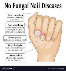 Illustration Of Five Different Non Fungal Nail Diseases Download A Free Preview Or High Quality Adobe Illustrator Nail Tech School Nail Techniques Fungal Nail