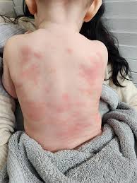 Image result for sweat rash on back baby