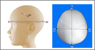 ما هو مؤشر الرأس ولماذا هو مهم في علاج التحام الدرز السهمي؟