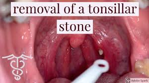 The symptoms of yeast is allows bacteria and post nasal drip. Tonsil Stones The Good The Bad And The Ugly