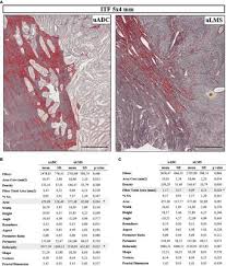 Montana yao, wife of minnesota timberwolves guard malik beasley, is. Characterizing The Invasive Tumor Front Of Aggressive Uterine Adenocarcinoma And Leiomyosarcoma Cell And Developmental Biology Frontiers