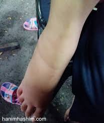 Video kali ini tentang 5 bahan alami atasi kaki bengkak dengan cepat. Petua Melegakan Bengkak Akibat Gigitan Serangga Nukilan Budak Flat