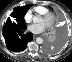 A collection of fluid on one side of the chest is a common sign of mesothelioma and a few other types of cancer. Malignant Pleural Mesothelioma Evaluation With Ct Mr Imaging And Pet Radiographics
