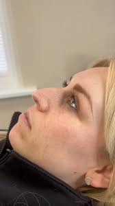 We love a good transformation 👃🏼💉, Subtle but noticeable! We’ve started  with a little tweak! Can’t wait for the next treatments!