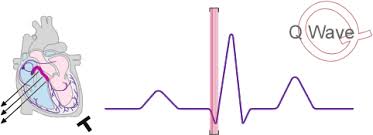 Image result for Q Wave