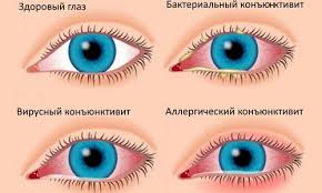 как избавиться от кашля у ребенка в домашних условиях Konyuktivit Lechenie Tradicionnymi I Narodnymi Sredstvami Glaza Lekarstvo Ot Kashlya Fakty O Zdorove