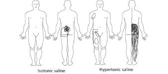 Superimposed Body Chart Pain Drawings N 30 Following