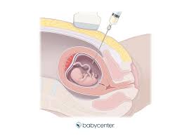 The nuchal translucency scan (also called the nt scan) uses ultrasound to assess your developing baby's risk of having down syndrome (ds) and some other chromosomal abnormalities, as well as major congenital heart problems. Nuchal Translucency Scan Nt Scan Babycenter