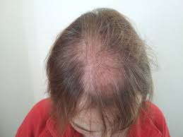 Foren sind nützliche plattformen zum austausch. Forum Haarausfall Frauen Forum Frauen Meine Haartransplantation Bei Hattingen Marz 2013