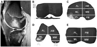 Diese verarbeitung erfolgt gemäß der geltenden. The Anterior Cruciate Ligament Injury Controversy Is Valgus Collapse A Sex Specific Mechanism British Journal Of Sports Medicine
