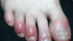 Check spelling or type a new query. Why Are My Toes Red Causes Other Symptoms And Treatments