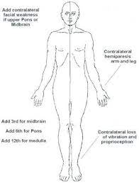 Medial Medullary Dejerine S Syndrome Anatomical Basis Mnemonic Epomedicine