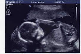 Gambar scan bayi dalam kandungan ultrasound baby 6 bulan scan jantina bayi koleksi resepi face mask kain cotton tips keibubapaan. Petua Baru Mudah Ketahui Jantina Anak Dalam Kandungan Mynewshub