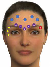 The forehead, for the treatment of forehead lines and one of several sites for the treatment of migraine Facial Contouring By Using Dermal Fillers And Botulinum Toxin A A Practical Approach Springerlink