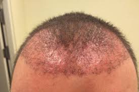 Die vielversprechendste seite dieser operation ist, dass die haare in dem verpflanzten gebiet natürlich wachsen. Haartransplantation Turkei Erfahrungen Mein Wahrer Erfahrungsbericht
