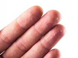 Hand Eczema May Cause Skin Peeling On Fingertips Peeling Fingertips Peeling Skin Dry Hand Skin