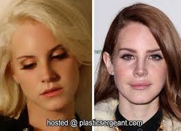 Lana Del Rey S Lips Augmentation Lip Augmentation Lana Del Rey Lips Beauty