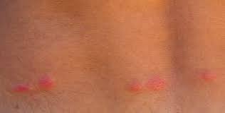 Image result for flea bites