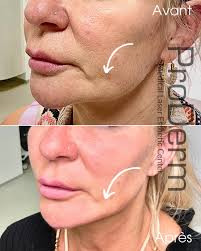 Sculptra ou fillers : pas toujours facile de s'y retrouver. Dre Cindy  Bouchard vous explique la différence, simplement et clairement 🤎 . . . . .  . #fillerinjection #agentdecomblement #sculptra #biostimulant  #medicoesthetique #injections #filler