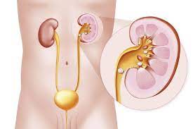 Maybe you would like to learn more about one of these? Rawatan Eswl Untuk Batu Buah Pinggang
