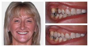 Dental Implants Testimonials