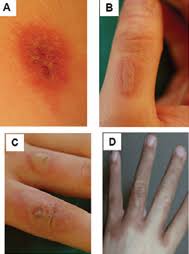 Image result for Photodermatitis