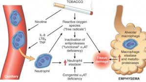 emphysema physiopedia