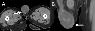 Am j surg pathol 1988; Imaging Appearance Of Cystic And Solid Mesothelioma Of The Tunica Vaginalis Sciencedirect