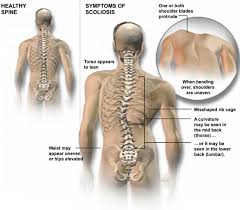 In most cases, left rib cage pain is due to a benign, treatable condition. Scoliosis Symptoms And Treatment Southeastern Spine Institute