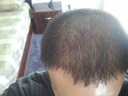 Sometimes, a tingling scalp can be the result of a skin or scalp condition. Itchy Burning Painful Tingling Scalp Issues Hairlosstalk Forums