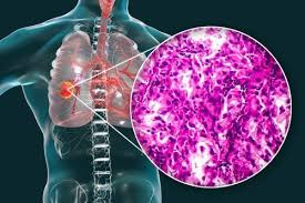 Others do have symptoms but, because those symptoms are so vague Histological Diagnosis And Classification Of Lung Cancers