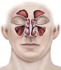 The nasal polyp treatment consists of either a reduction or a complete nasal polyp removal. Endoscopic Sinus Surgery Healthdirect