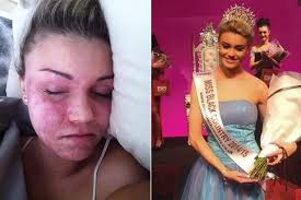 Girl bullied over severe eczema so bad she was called 'snake-skin' becomes  beauty queen