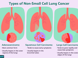 Aggressive assessment of symptoms and use of palliative therapies can significantly reduce the symptomatology of advanced lung cancer. Early Stage Lung Cancer Overview And More