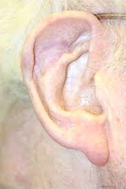 Ear cancer is a rare disease that can spread to other areas of the body. Ear Cancers Basal And Squamous Cell Bcc And Scc Cancers And Melanoma