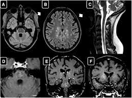 Differential diagnosis, clinical and mri characteristics of clippers syndrome as well as treatment approaches are discussed. Clippers Like Mri Findings In A Patient With Multiple Sclerosis Journal Of The Neurological Sciences