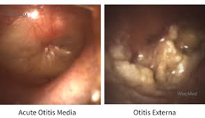 Image result for Acute Otitis Externa