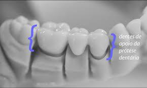 Protese Dentaria Fixa O Que E Os Tipos E O Melhor Material Explicados