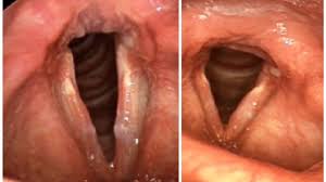 Image result for Acute Laryngitis