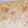 Actinic keratosis (ak) is the most common precancer that forms on skin damaged by chronic exposure to ultraviolet (uv) rays from the sun and/or indoor tanning. 1