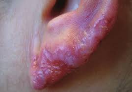 We did not find results for: Lupus Vulgaris Source Dermnetnz Org Download Scientific Diagram