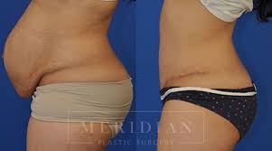 Body Contouring Austin Tx Meridian Plastic Surgery