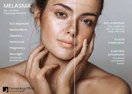 Image result for Melasma