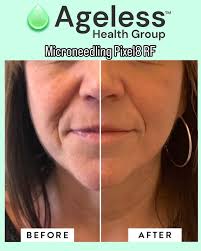 Build Collagen, Restore Confidence! Ready to glow this spring? Rejuvenate  your skin and stimulate collagen production with our Pixel 8 RF treatment  at Ageless by Isabelle Wilcox! Book your appointment online at