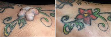 More advanced devices (icd, implantable cardioverter defibrillator; Tattoo Associated Complications And Related Topics A Comprehensive Review Petrochko Jm Krakowski Ac Donnelly C Wilson Jb Irick Jb Stawicki Sp Int J Acad Med