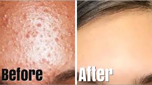 Symptoms of fungal acne or pityrosporum folliculitis can include: How To Really Get Rid Of Small Forehead Pimples Youtube